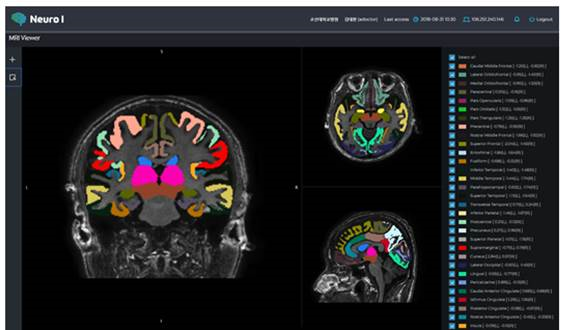 조선대 치매국책연구단은 MRI에서 단층 촬영된 뇌사진 200장을 활용해 3차원으로 재구성된 뇌영상에서 80개로 세분화된 영역별로 분석이 가능하며 사용자가 지정한 영역에 대한 정량적 상세정보를 제공함으로써 원하는 뇌 부위의 미세한 변화도 분석비교가 가능하다고 밝히고 있다. ⓒ조선대학교 제공